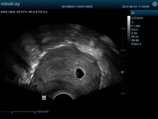 Mindray™ Z5 Portable Color Ultrasound System - Mindray USA - Image 3