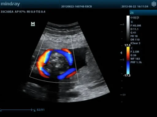 Mindray™ Z5 Portable Color Ultrasound System - Mindray USA - Image 6