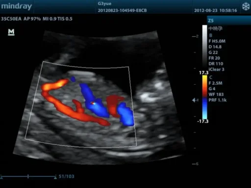 Mindray™ Z5 Portable Color Ultrasound System - Mindray USA - Image 5