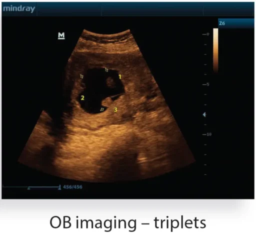 Mindray™ Z6 Portable Ultrasound System - Mindray USA - Image 6